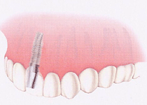 インプラントが支持する歯冠（人工歯）