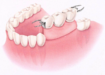 可撤性部分床義歯（パーシャルデンチャー）　取り外し式の部分入れ歯