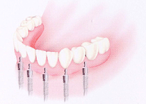�Aインプラント支持の固定式義歯（ブリッジ）